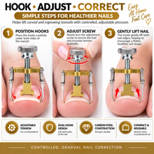 Load image into Gallery viewer, Ingrown Toenail Corrector Clamp – Professional Nail Correction Tool