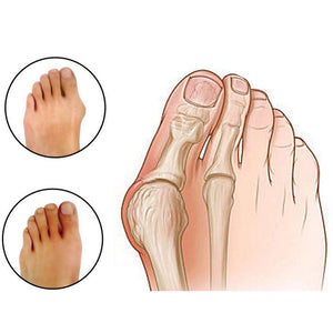 Glamza Splint Corrector Device Pair
