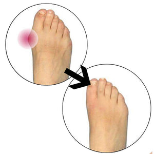 Glamza Splint Corrector Device Pair
