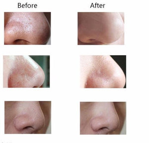 Pore Cleansing Blackhead, Pimple, Zit & Acne Remover